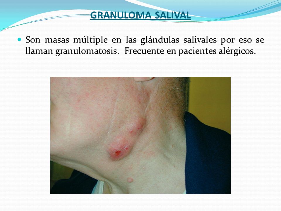 Glandula salival obstruida en ninos